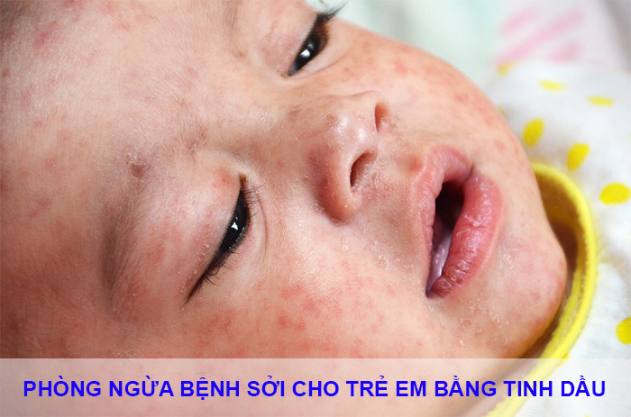 phong ngua benh soi cho tre em