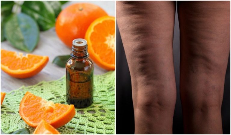 CELLULITE – Da Sần Vỏ Cam ? Hãy Để Tinh Dầu Xử Lý !